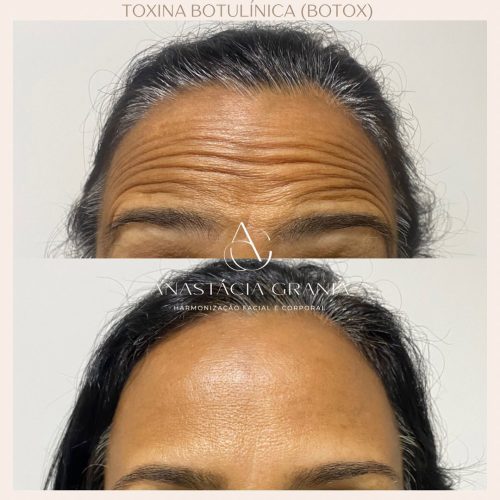 Anastacia Granja - Especialista em Harmonização Facial