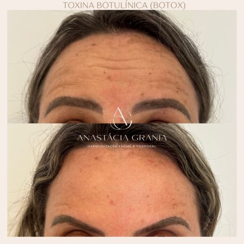 Resultado Harmonização Facial