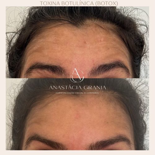 Harmonização - Antes e Depois