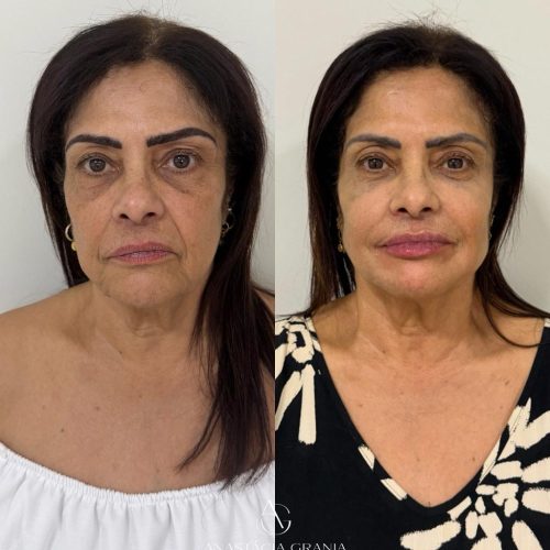 Botox - Resultado Natural